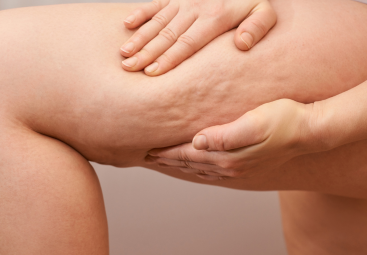 Cellulite aus drei Perspektiven: Westliche Medizin, TCM & Ayurveda